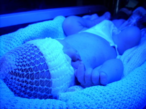 jaundice in newborns